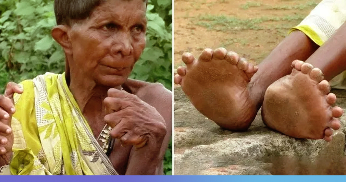 Odisha Woman With 20 Toes,12 Fingers Branded As Witch, Shunned Out Of Village