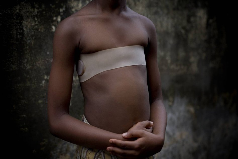 Breast Ironing: The Tradition Of Girls Breasts Being Flattened With Hot Stones And Metal