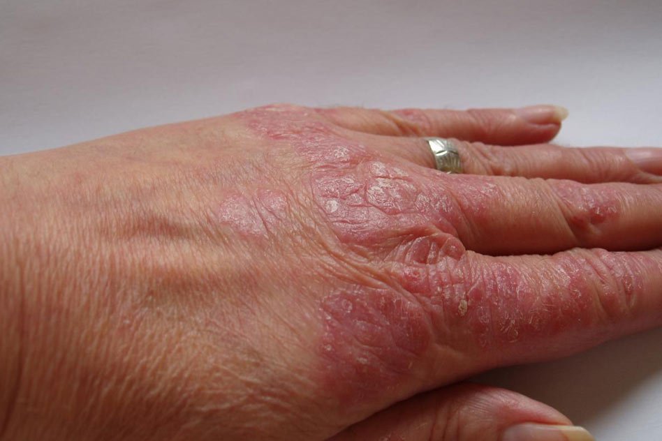 All You Need To Know About This Disease- Causes, Symptoms And Treatments