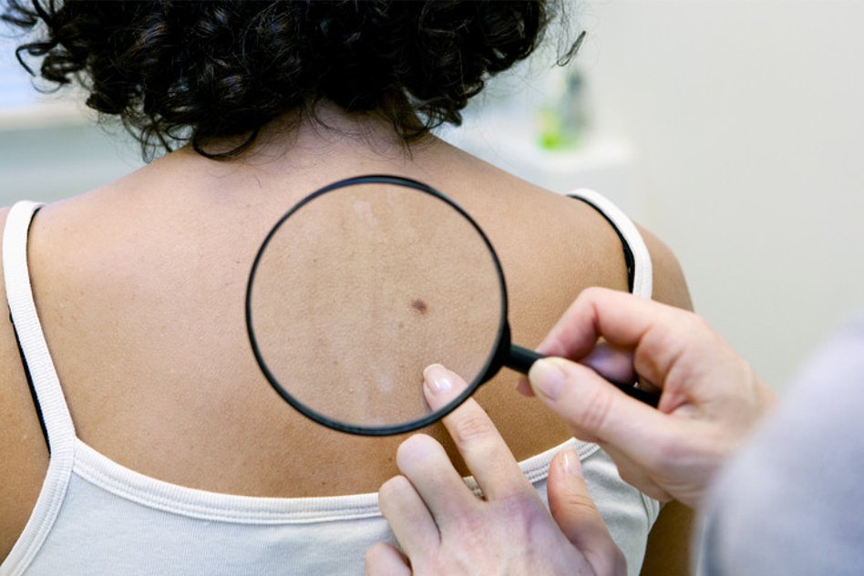 5 Easy Tips To Keep Skin Cancer At Bay