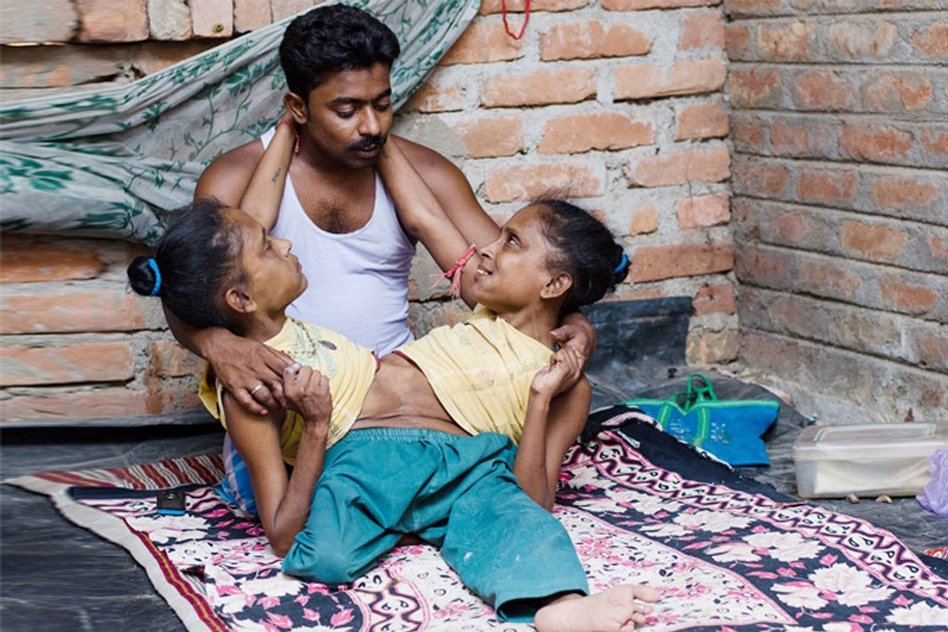 A Love Story Like Never Before: Conjoined Sisters Find Love With The Same Man
