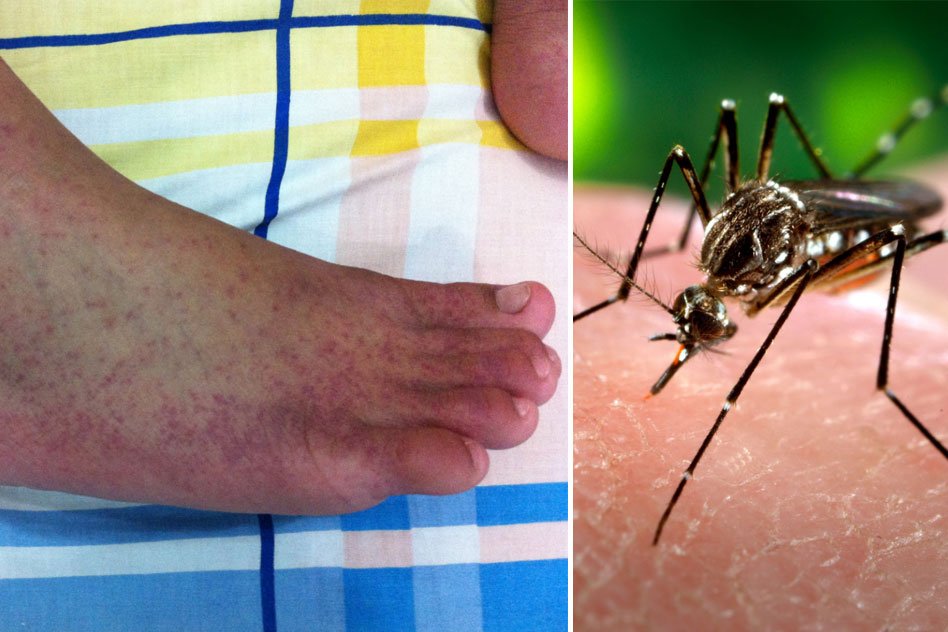 Chikungunya And Dengue Kills 30 In Delhi, All You Need To Know About The Outbreak
