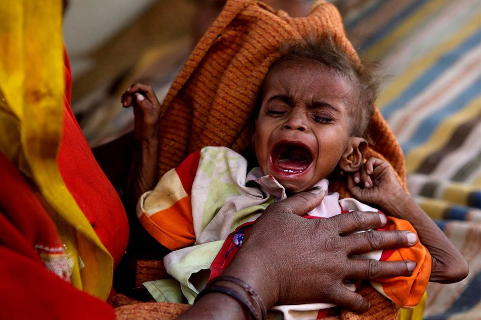 Malnourishment Grips Children In Sheopur District Of MP, Number Of Deaths Increasing Every Month