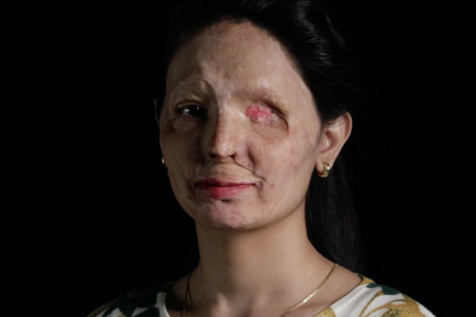 [Watch/Read] Her Sister Told Her To Run, But They Held Her Down And Poured Acid On Her Face