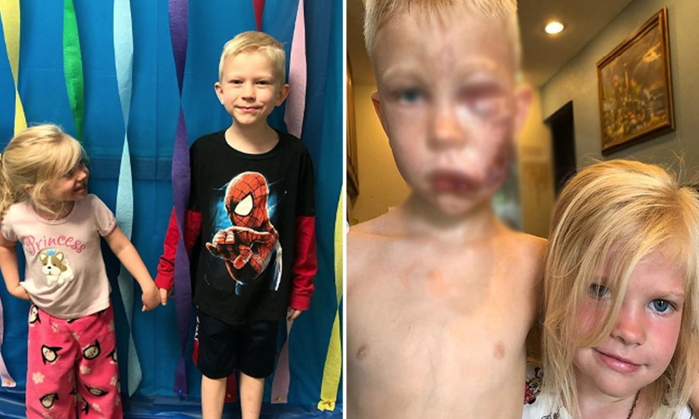 6-Yr-Old Boy Gets 90 Stitches After Saving Little Sister From Dog Attack IN US, Wins Praise