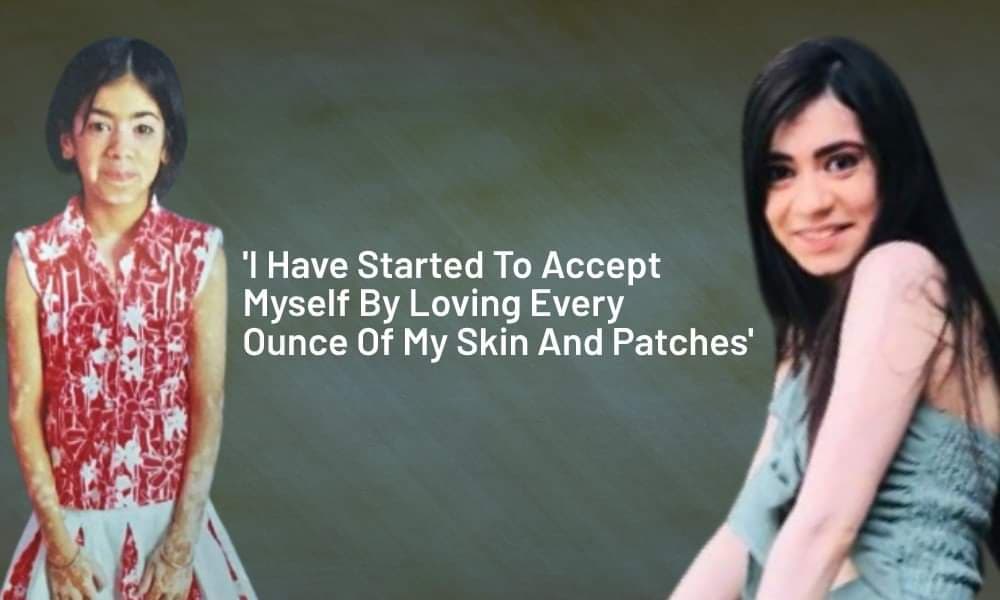 My Story: I Have Started To Accept Myself  By Loving Every Ounce Of My Skin And Patches