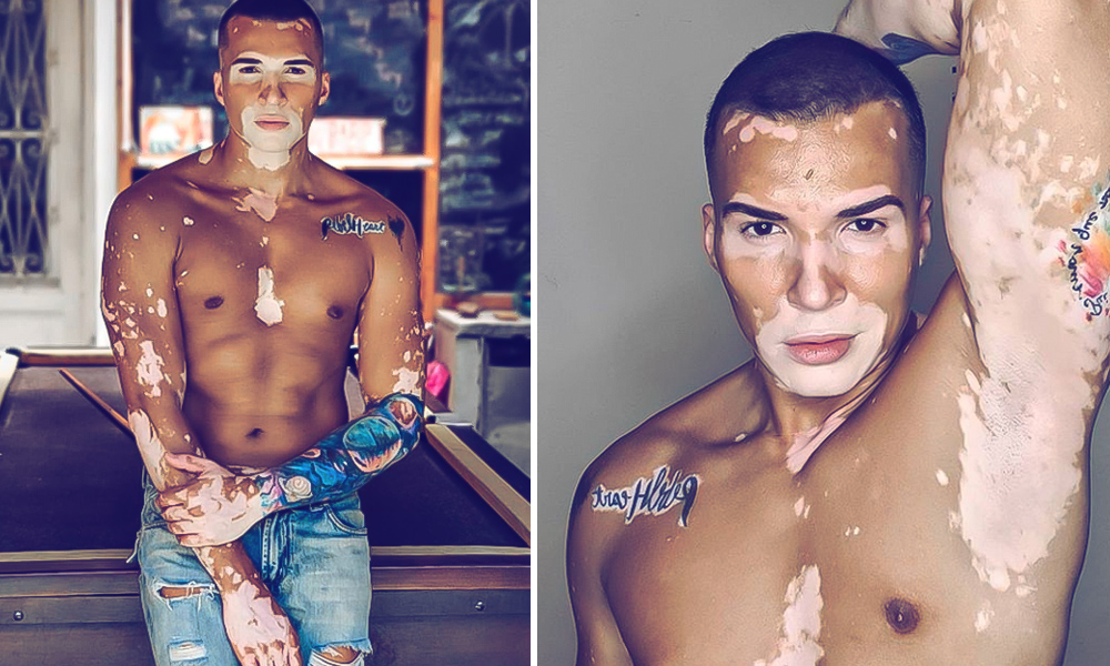 Flaunt It With Pride: This Brazilian Model With Vitiligo Who Once Hid Behind MakeUp, Tattoos Is Now Inspiring Many
