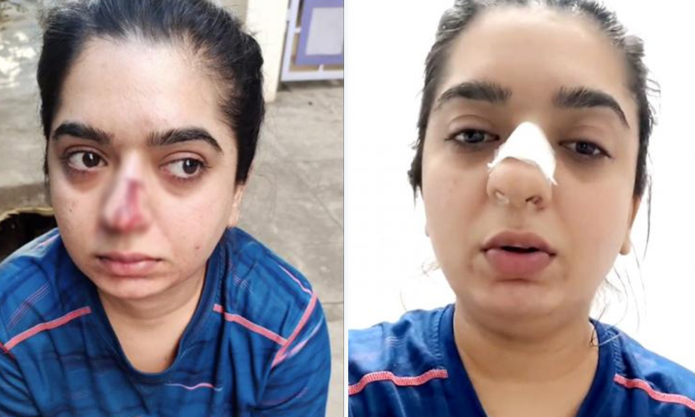 Bengaluru Woman Allegedly Attacked By Zomato Valet After Argument Over Late Delivery