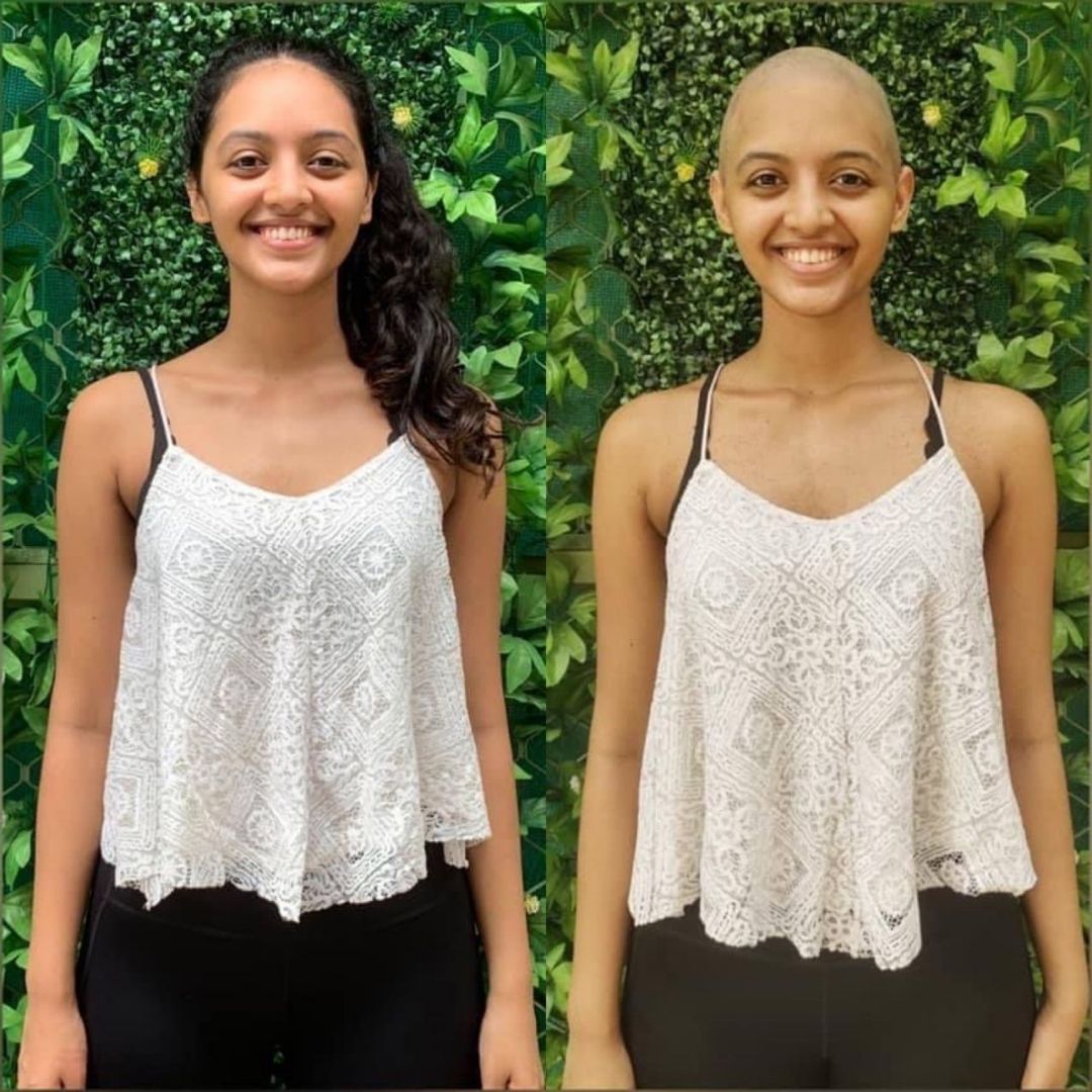 My Story: I Wanted To Show My Solidarity To Cancer Patients And Emphasize That Bald Is Beautiful Too