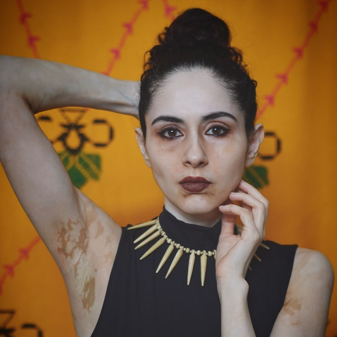 This Content Creator From Delhi Is Raising Awareness On Vitiligo And Defying Societal Expectations On Appearances