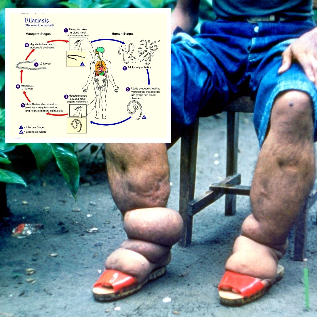 Impact Of Lymphatic Filariasis On Affected Community- All You Need To Know
