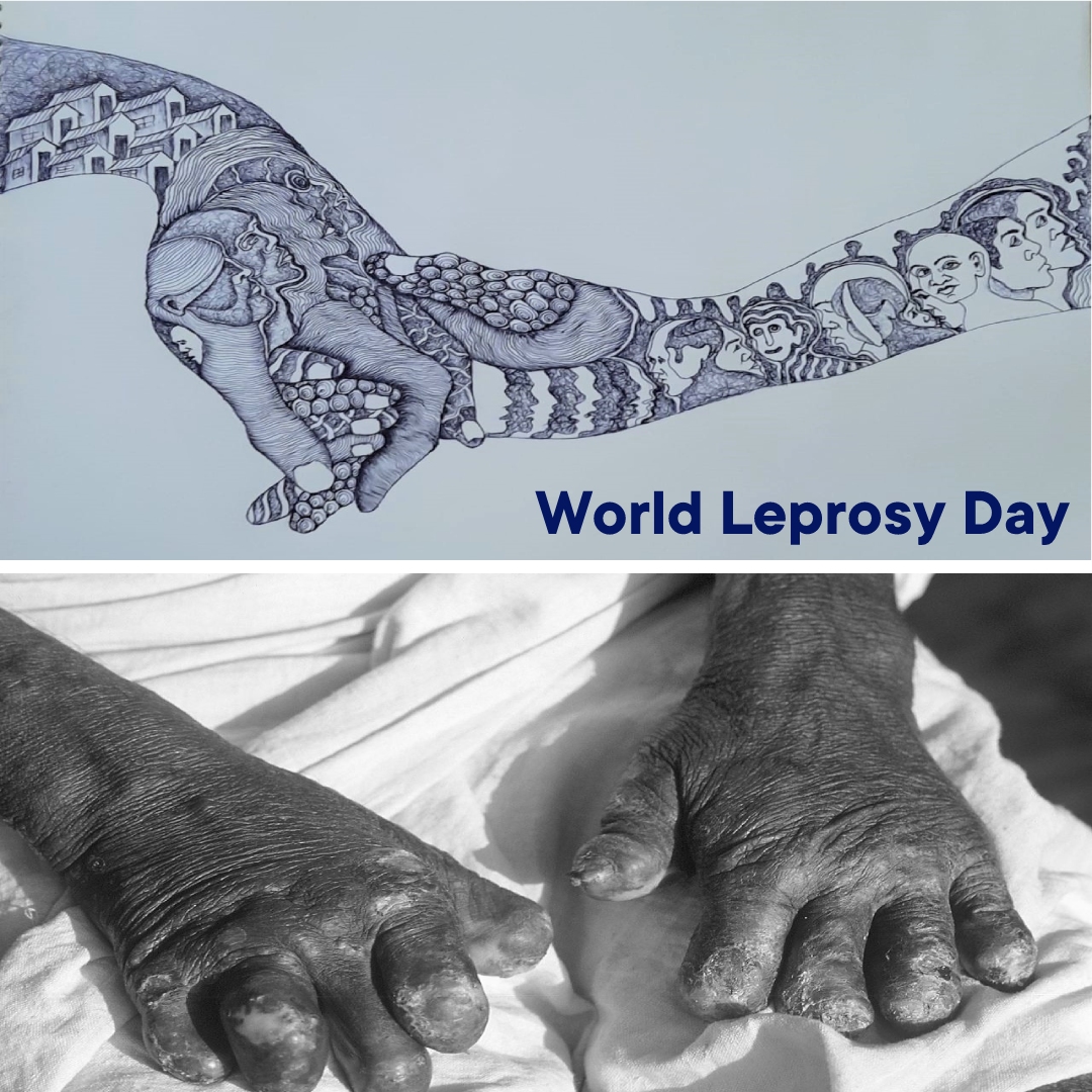 World Leprosy Day 2022: Standing With Missed-out Leprosy Affected People Amid Pandemic