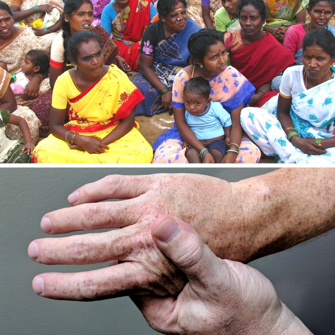 One In Three Women In Rural Delhi Suffers Bone Ailments, Diseases: Study