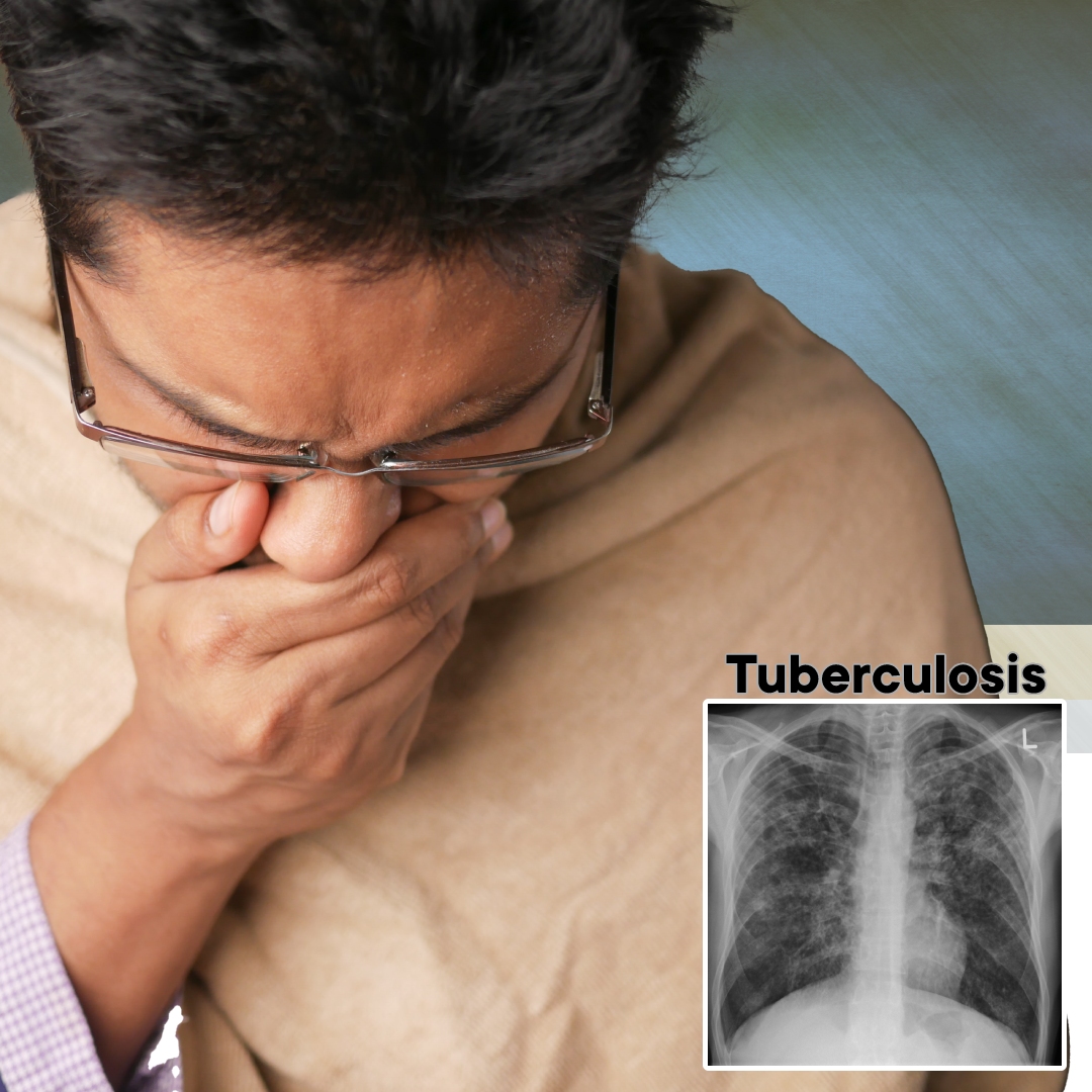 Three Telangana Districts Recognized For Their Efforts To Combat Tuberculosis