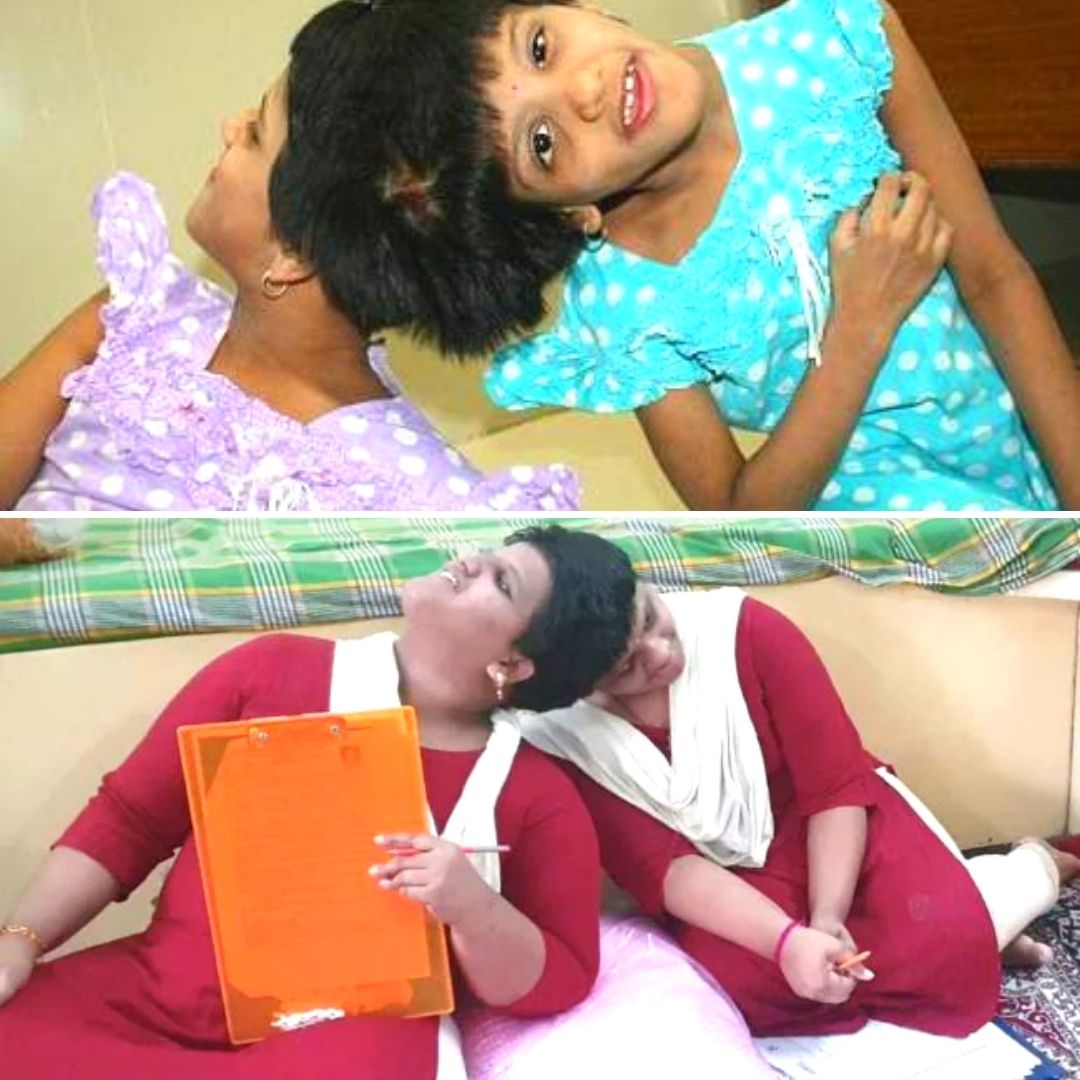 Defying All Odds! Hyderabad Conjoined Twins Take Class 12 Exams, Refuse Any Special Privilege