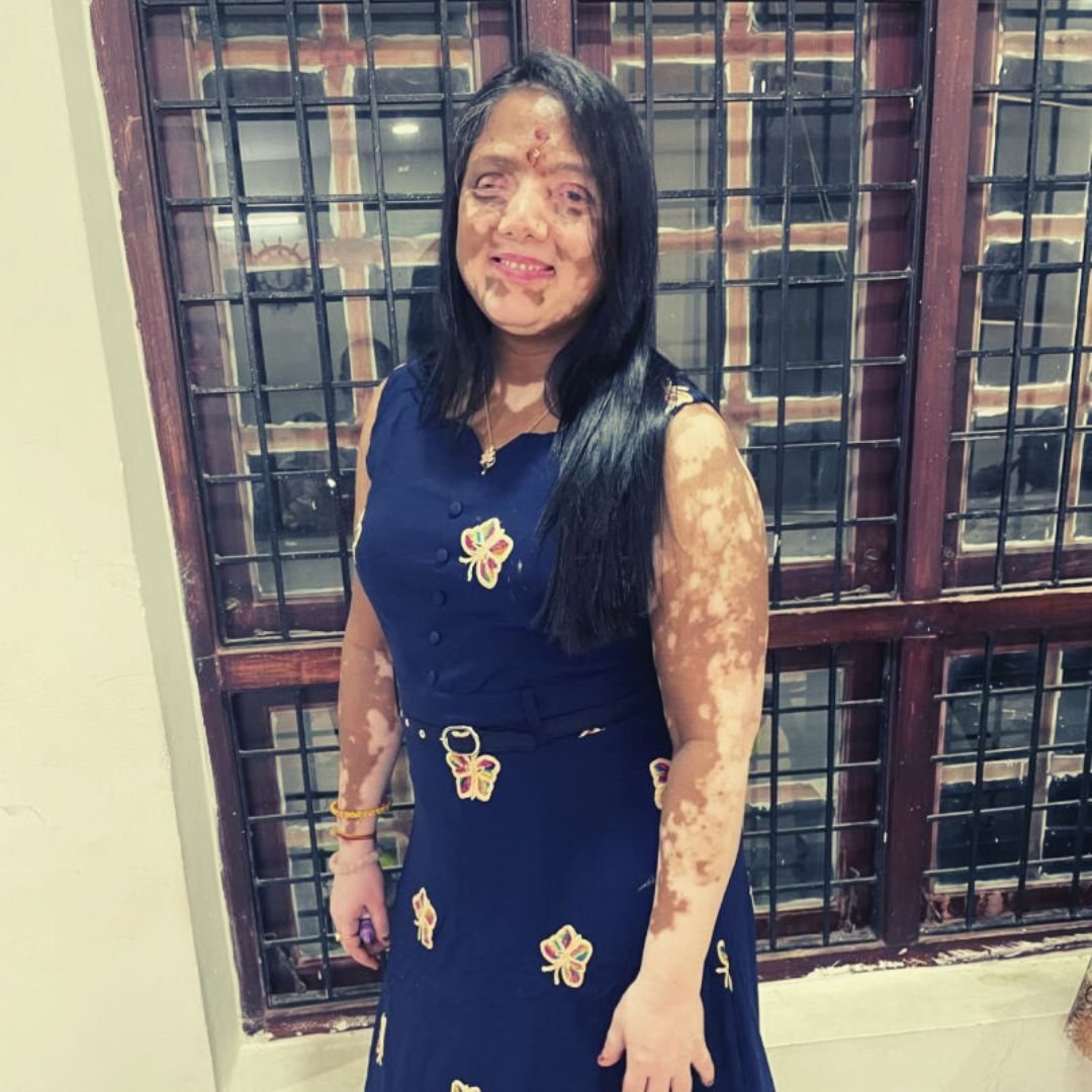 My Story: My Vision Impairment And Vitiligo Couldnt Stop Me Living Life With Dignity