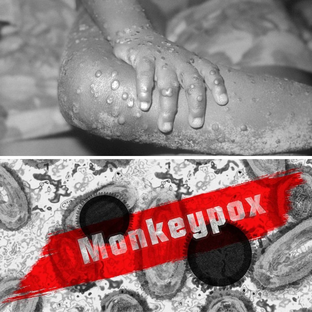 AP: Monkeypox Symptoms Detected In 8-Yr-Old Boy In Guntur, First Patient Discharged After Testing