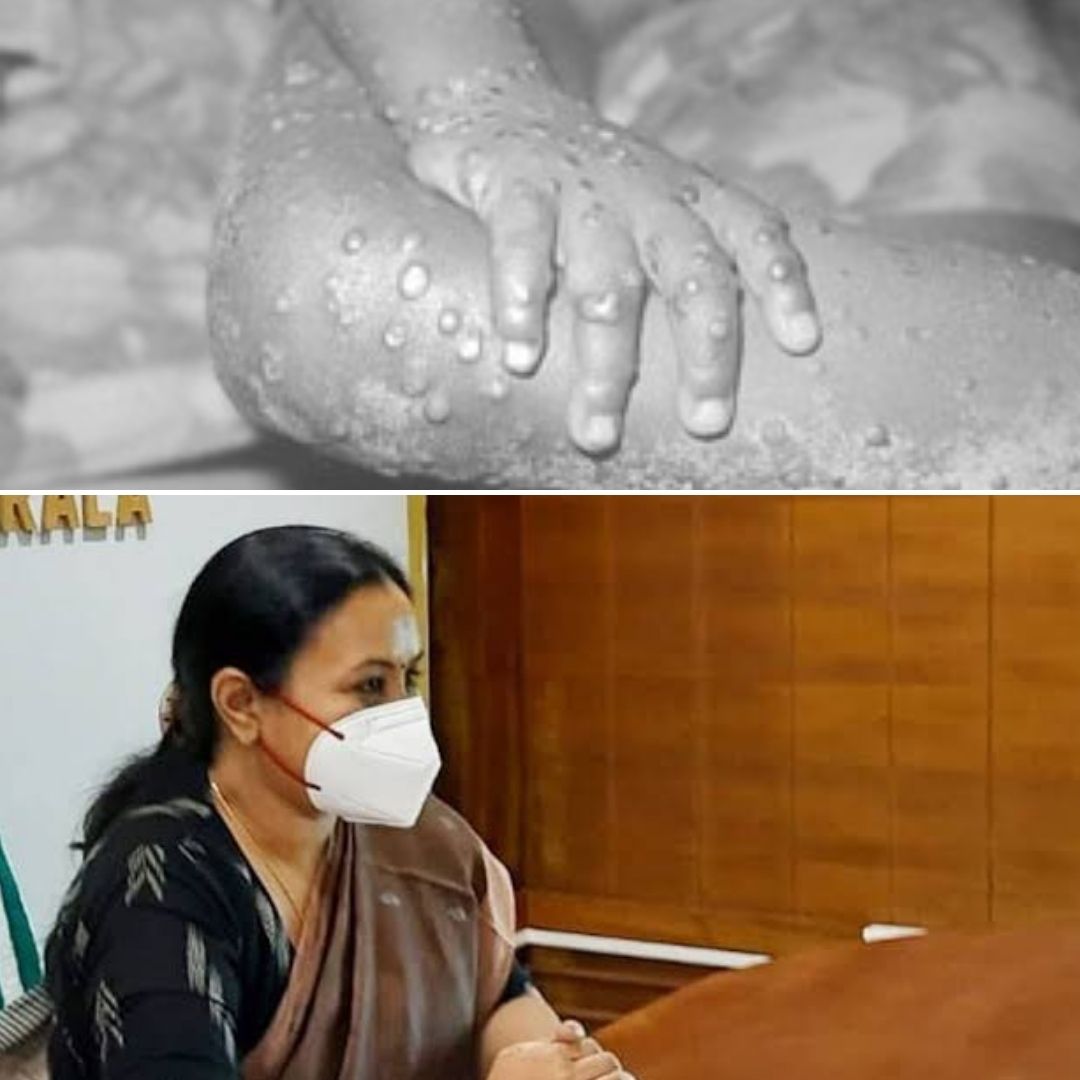 Kerala Man Who Tested Positive For Monkeypox Dies In Thrissur, Govt Initiates High-Level Inquiry
