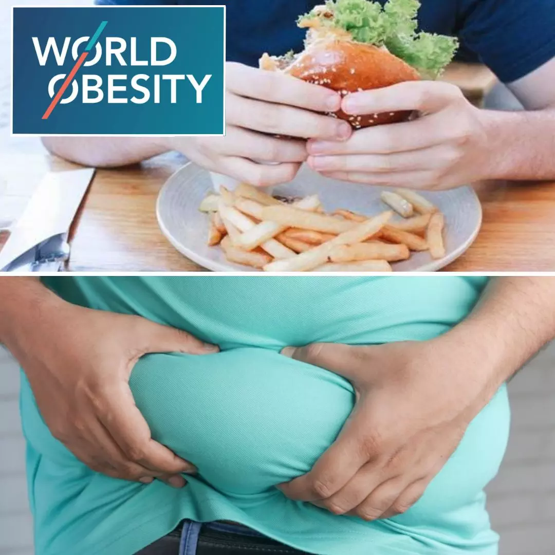 Obesity Likely To Affect More Than Half Of Global Population By 2035, Says Study