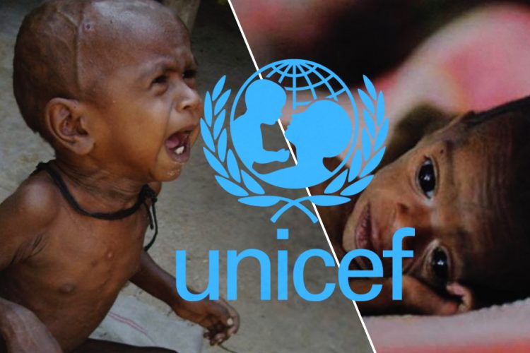 UNICEF Malnutrition Children